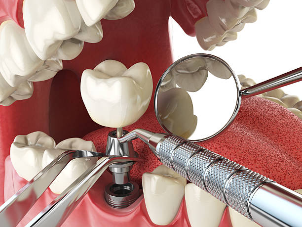 Best Emergency Denture Repair in La Crescenta Montrose, CA